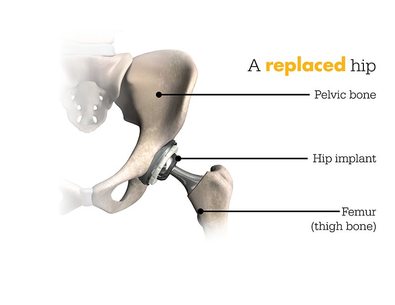 Diagram of replaced hip